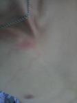 Сыпь на коже с дальнейшим расползание на вены фото 1