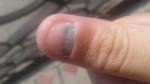 Проблема с ногтём после удара пальцем фото 1