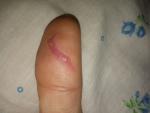 Рваная рана пальца фото 1
