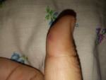 Рваная рана пальца фото 2