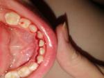 Травма нижних зубов фото 1