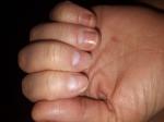 Проблемы с ногтями фото 4