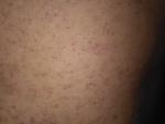 Сыпь на теле не аллергия фото 2