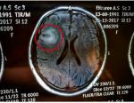 Опухоль правой лобной доли головного мозга фото 1