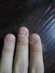 Проблемы с ногтями у грызущего человека фото 1