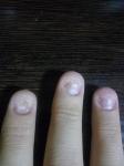 Проблемы с ногтями у грызущего человека фото 2