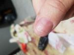 Мелонома ногтя фото 1