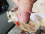 Мелонома ногтя фото 2