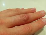 Болит кожа на среднем пальце руки фото 2