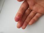 Аллергия на пальцах рук, не проходит уже почти 3 месяца фото 1