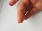 Аллергия на пальцах рук, не проходит уже почти 3 месяца фото 2