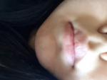 Шелушение на щеках вокруг рта глаз фото 1