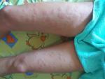 Пищевая аллергия или инфекция, передающаяся комарами? фото 1