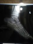 Боль в ногах у ребёнка вальгусное плоскостопие 2 степени фото 2