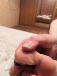 Болячки на большом пальце ноги фото 2