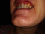 Очень плохие зубы, десна фото 2