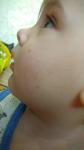 Прыщи, покраснение на щеках у ребенка до года без зуда фото 2