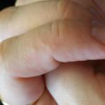 Сыпь на пальцах 33 недели беременности фото 1