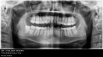 После лечения кариеса зуб реагирует на холодно, горячее, твердое фото 1