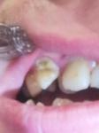 Кариес зуба фото 1