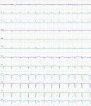 Интерпретация ЭКГ фото 1