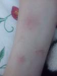 Кожаные заболевания, Аллергия фото 3
