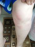 Пятна-воспаления на ногах фото 3