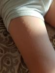 Сыпь у ребенка на руках и ногах фото 2