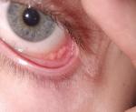 Воспаление слизистой глаза фото 1