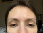 Халязион. Бугристый воспалённый глаз после операции фото 1
