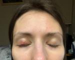 Халязион. Бугристый воспалённый глаз после операции фото 2