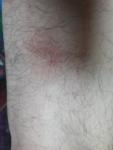 Красные пятна на ноге (не болят) фото 2