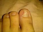 Сломанный ноготь на большом пальце ноги фото 1