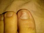 Сломанный ноготь на большом пальце ноги фото 2