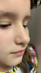 Высыпания на лице у ребенка 8 лет фото 1