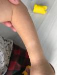 Белое пятно на руке ребёнка фото 1