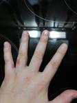 Сильное покраснение кожи пальца на руке фото 3
