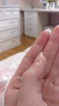Уплотнение возле ногтевой пластины большого пальца руки фото 2