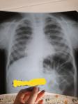 Проблемы с кишечником (описание рентген. Снимка) фото 1