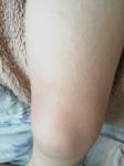 Мелкая сыпь на ножках у 2х-летнего ребёнка фото 3