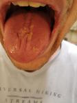 Воспаление слизистой языка, потеря вкуса, набухшие сосочки фото 3