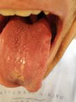 Воспаление слизистой языка, потеря вкуса, набухшие сосочки фото 1