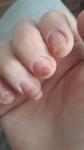 Болезнь ногтей фото 1