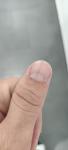Полоса на ногте большого пальца левой руки фото 1