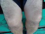 Проблема с коленным суставом фото 1