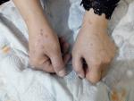 Аллергия на руках и на теле фото 1