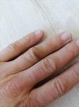 Воспаление сустава на пальце руки фото 1