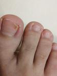 Проблема ногтевой пластины на ноге, в течении 3 месяцев фото 1