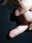Гнойнечок возле ногтя фото 1