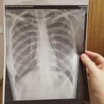Расшифровать рентген лёгких фото 1